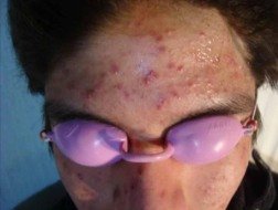 Frente con acné activo y marcas antes del tratamiento